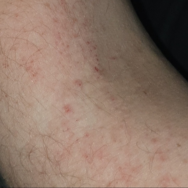 munitie Onaangeroerd dempen Droge huid en vochtarme huid - Huidtherapie SkinShine